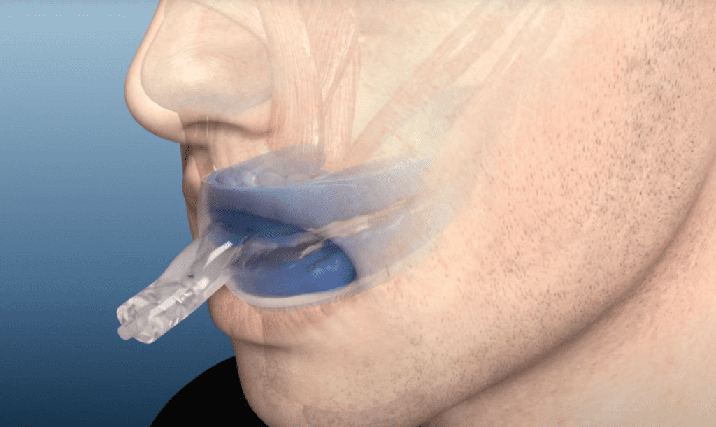 Airway Management TAP 3 Elite oral appliance for sleep apnea