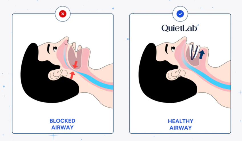 how the quietlab anti-snoring mouthpiece works